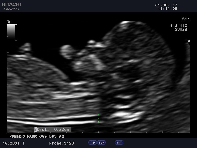 Ultrasound Scans During Pregnancy - Are They Safe?