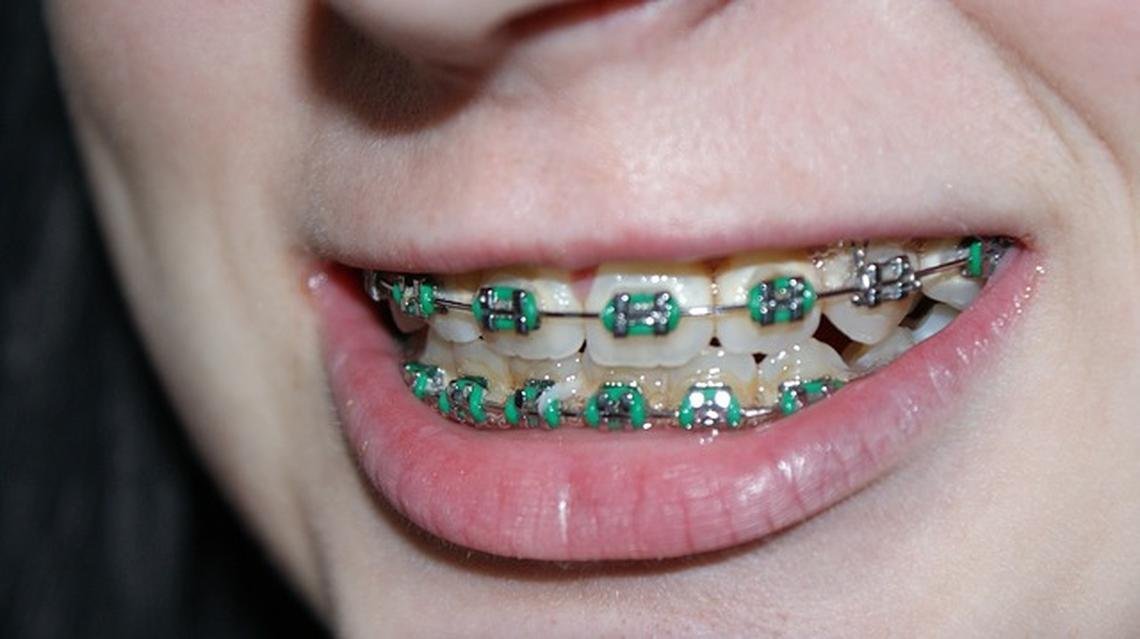 Caring For Children With Dental Braces