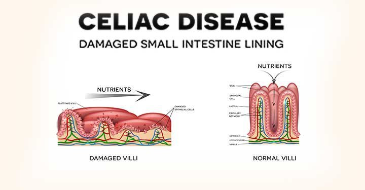 What Is Celiac Disease? Causes, Symptoms And Treatment