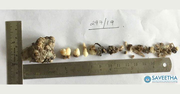 The Boy With 526 Teeth!