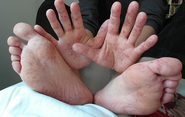 Hand, Foot And Mouth Disease In Children: Causes, Symptoms And Treatment